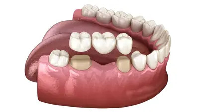 Examples of dental crowns and bridges